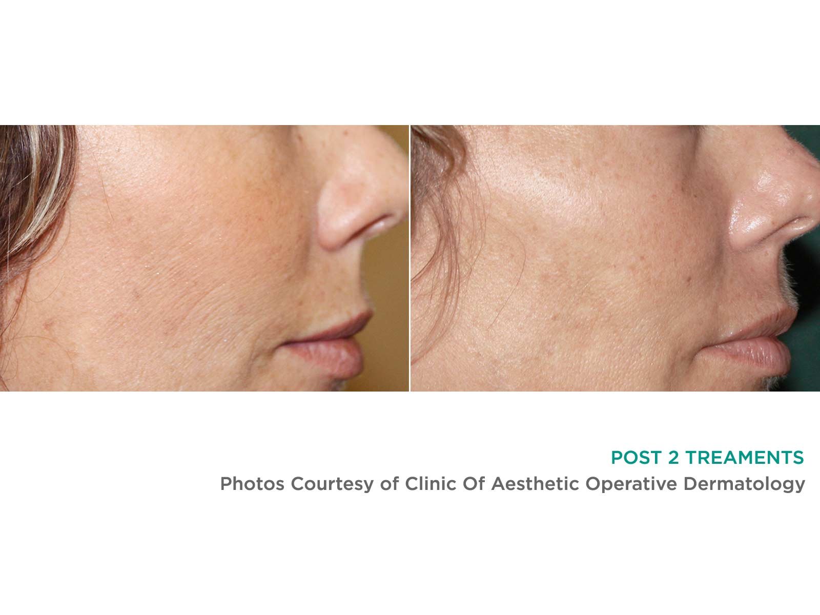 Post 2 treatments result