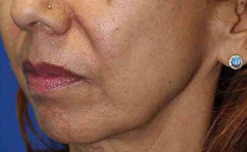 After Secret RF treatment - Skin Texture